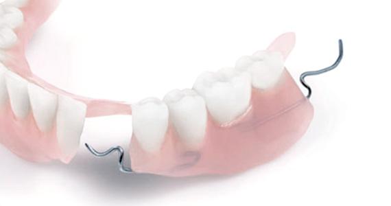 Partial-denture-curved-570x300